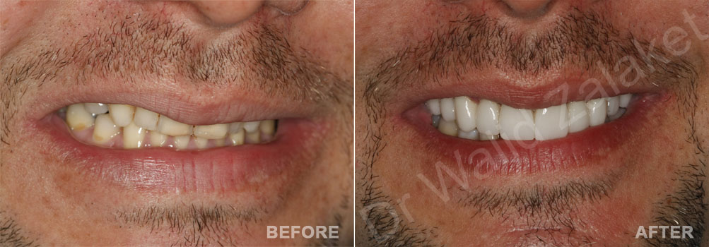 Male lip enhancement