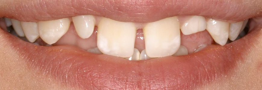 Teeth Gaps